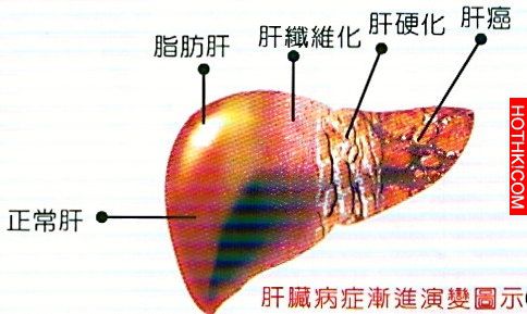 原來肝病跟肝硬化居然是有救的！！只要每天靠＂這個＂，效果真的太神奇了！平常多吃也 ...