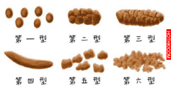 國人大腸癌罹患率「不斷上升」，要預防大腸癌就要先認識自己的「糞便」，第二型竟然是 ...