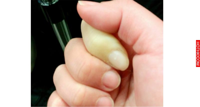 驚！網友早上醒來，手指整隻變白！！原因竟然是…