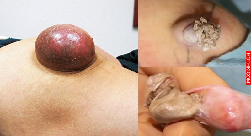 他才不是大痘痘！！長這樣的其實是種「瘤」！沒想到每個人全身都會長，說不定你也有一 ...
