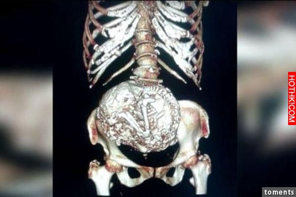 91歲老婦腹部被檢查出有腫塊，但診斷後卻發現了一個驚人的事實