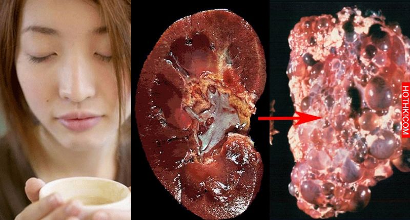 喝茶之後就千萬別吃「這個」，否則你的腎會壞光光！！一定要小心啊！！ ... ...