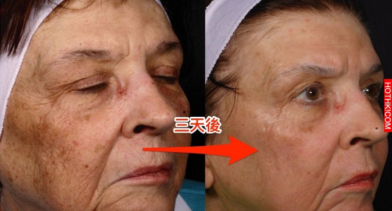 再也不用雷射了！「老人斑」竟然三天就消失了！只需要白開水加上...，簡單製作又好喝 ...