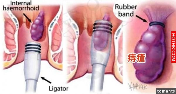 不用再為痔瘡而苦了！！教你＂這方法＂馬上自然根除，屁屁不再癢癢！只要這樣做...太 ...