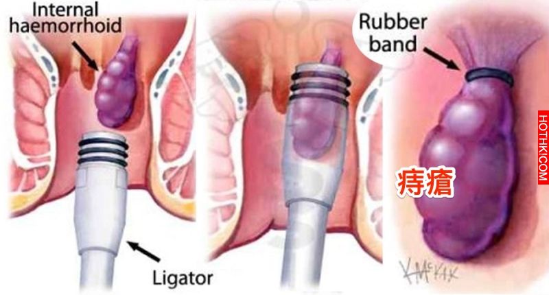 痔瘡終於有解了！教你三種方法自然根除，屁屁不再癢癢！只要這樣做...簡簡單單！ ...