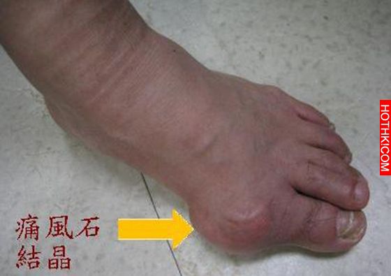不敢相信多年的痛風居然靠這就解決了！！可惜太晚才知道.... ...