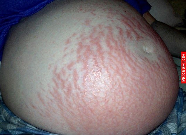 太絕了！產後「西瓜妊娠紋」只要這樣做....沒幾下就速速復原3歲嫩肚皮！（附贈五步按 ...