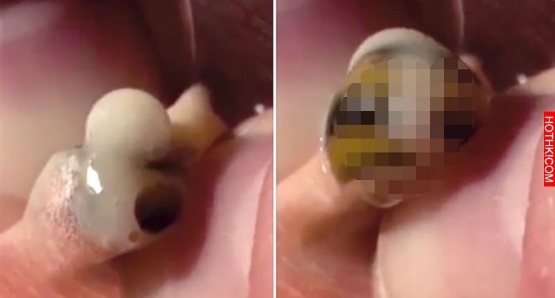 小男童去度假時膝蓋生了小傷口，沒想到回家後一擠竟然出現「這種東西」！噁心到我已經 ...