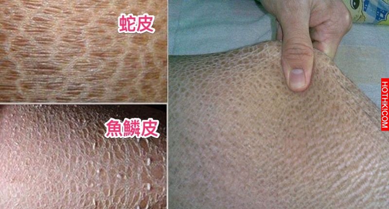 冬天腿上乾燥多層乾皮怎麼辦？只要多一步，包準你三天內水嫩會反光！就怕你太晚知道.. ...