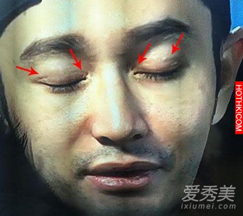 明星不承認整容 這些疤痕怎麼解釋？