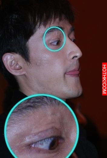 明星不承認整容 這些疤痕怎麼解釋？
