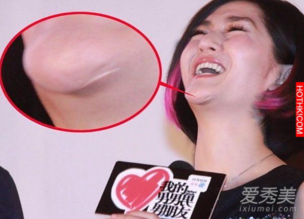明星不承認整容 這些疤痕怎麼解釋？