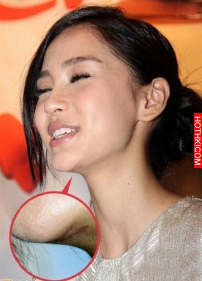 明星不承認整容 這些疤痕怎麼解釋？