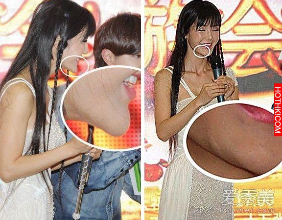 明星不承認整容 這些疤痕怎麼解釋？