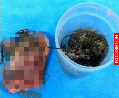 45歲女子突然來了大量月經，去檢查時卻震驚了整間醫院