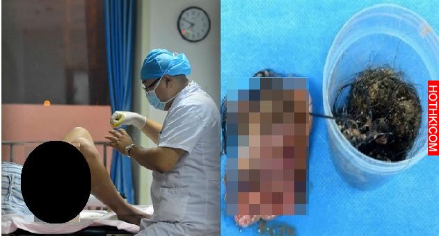 45歲女子突然來了大量月經，去檢查時卻震驚了整間醫院