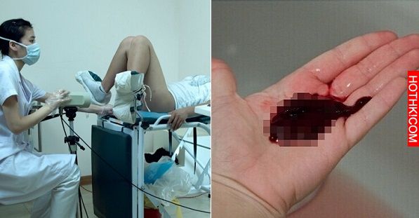 這女人突然來了大量月經，醫生「伸進去」檢查以後竟然發現裡面有...整間醫院都震憾了 ...