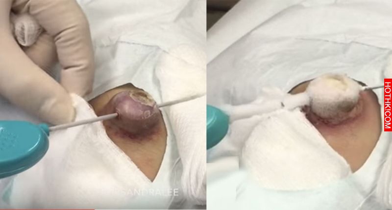 這人膝蓋生了果實大的腫疤，醫生拿長針穿過後，沒幾秒竟然瞬間出現驚悚變化，看到都尿 ...