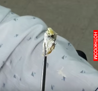 老阿公太久「沒清耳垢」就醫治療，沒想到竟挖出這種東西！這一幕，讓現場人全都嚇到叫 ...