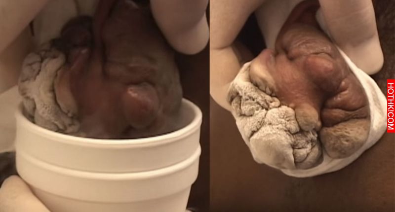 男子耳朵長了顆拳頭大的疙瘩，醫生不是用刀子，竟然用這種方法破壞他....這過程看到心 ...