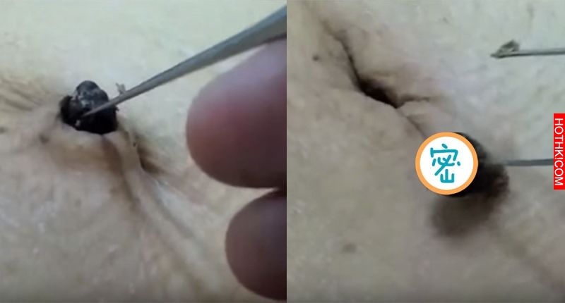 這人累積一個超深的「陳年黑頭」，一挖出後竟然出現超驚人的一幕....看的大家都立刻頭 ...
