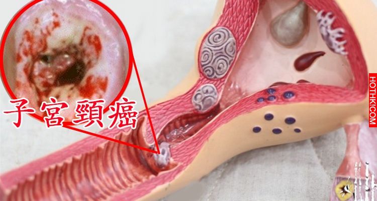 99%的人不知道！這個我們「常吃的菜」竟可殺死「子宮頸癌細胞」！！一定要分享出去！ ...
