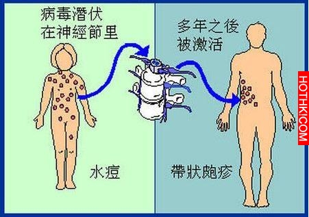 他因為帶狀皰疹去看病，卻發現了腫瘤