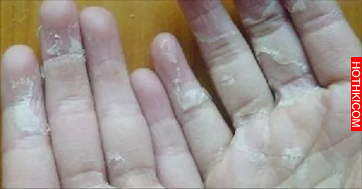 送大家一個獨家偏方；手脫皮、腳跟痛、手腳抽筋、腳雞眼、手腳皸裂的治療，要好好珍藏 ...