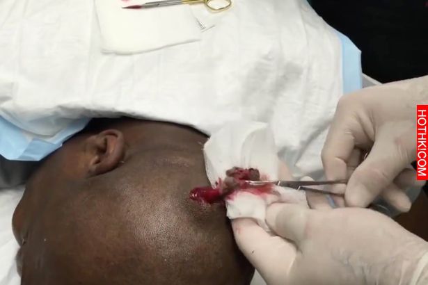 超巨大腫塊！醫生剪開後也「不敢相信自己眼睛」．．．那裡面到底是什麼東西呀~ ...