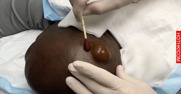 超巨大腫塊！醫生剪開後也「不敢相信自己眼睛」．．．那裡面到底是什麼東西呀~ ...