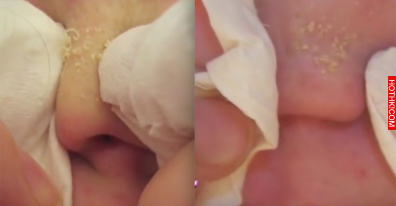 醫生在鼻頭上加了「這種東西」後輕輕擠壓，不斷噴發的「起司條」看的人大呼太爽了！ ...